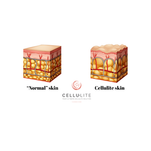 Cellutate Cellu.Lite - Your ultimate cellulite solution – cellu-lite.com