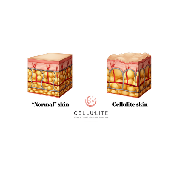 CELLULITE & HEALTHY SKIN: [5] THINGS THAT CAN HELP
