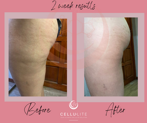 Ultimate Cellulite Starter Kit | 3 products